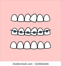 Illustration about dental healthcare with the image of braces on teeth. EPS10. 
Vector image of the stages of orthodontic treatment for posters for dental clinic in flat style.