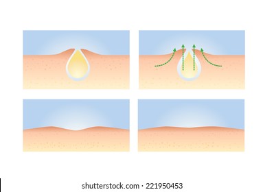 A illustration about step to acne skin treatment 