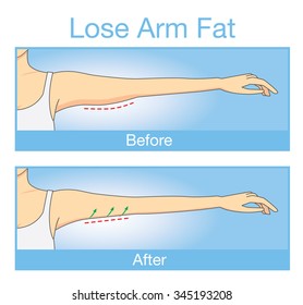 Illustration about step before and after of woman arm look tightening up after lose arm fat