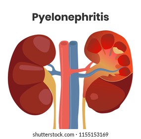 Illustration of the accute pyelonephritis with the pus inside the kidney and severe inflammation. Normal kidney is on the left with the affected kidney on the right