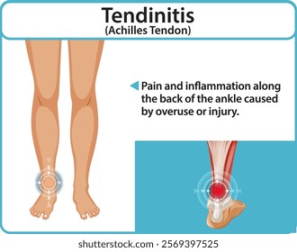 Illustration of Achilles tendon pain and inflammation