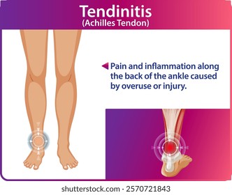 Illustration of Achilles tendon pain and inflammation