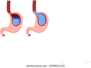 Illustration of Acid Reflux (GERD)