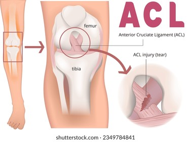 illustration of ACL injury Infographic 