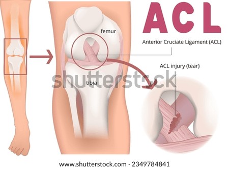 illustration of ACL injury Infographic 