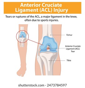 Illustration of ACL tear in the knee