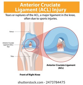 Illustration of ACL tear in the right knee