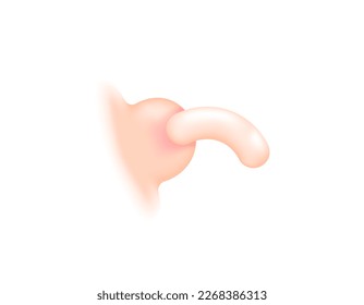illustration d'une bosse d'acné qui sécréte le liquide de pus. une tête noire sort de la peau. abcès. Illustrations 3d et réalistes. éléments vectoriels