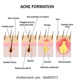 Illustration of acne formation on the human skin