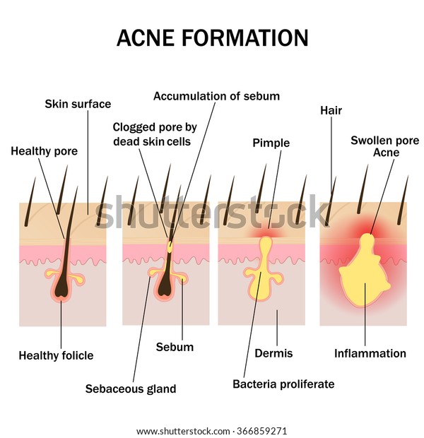 Illustration Acne Formation On Human Skin Stock Vector (Royalty Free ...