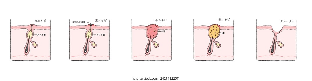 Darstellung der Aknestruktur und des Mechanismus, Schnittdarstellung