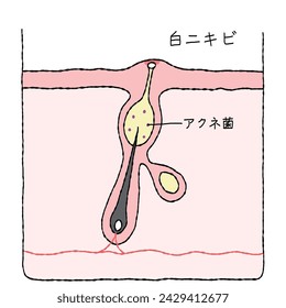 Illustration of acne structure and mechanism, cross-sectional view