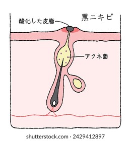 Illustration of acne structure and mechanism, cross-sectional view