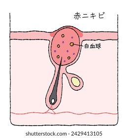 Illustration of acne structure and mechanism, cross-sectional view