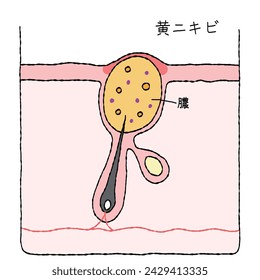 Illustration of acne structure and mechanism, cross-sectional view