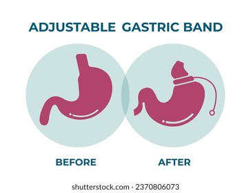 Illustration of Adjustable Gastric Band devise Weight Loss Surgery vector
