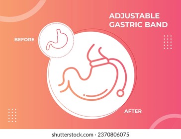 Illustration of Adjustable Gastric Band devise Weight Loss Surgery vector
