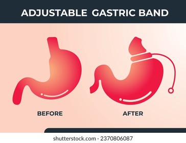 Illustration of Adjustable Gastric Band devise Weight Loss Surgery vector
