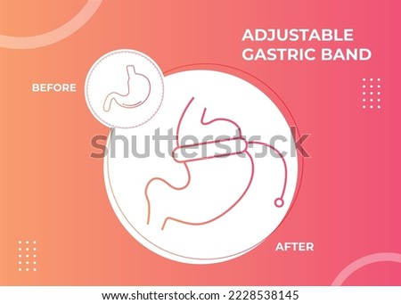 Illustration of Adjustable Gastric Band devise Weight Loss Surgery vector