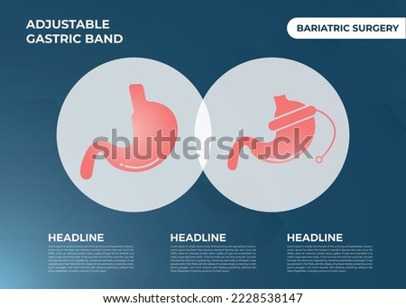 Illustration of Adjustable Gastric Band devise Weight Loss Surgery vector