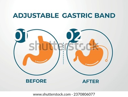 Illustration of Adjustable Gastric Band devise Weight Loss Surgery vector
