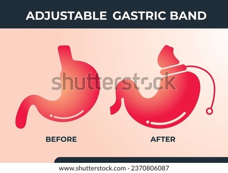 Illustration of Adjustable Gastric Band devise Weight Loss Surgery vector
