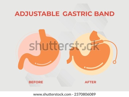 Illustration of Adjustable Gastric Band devise Weight Loss Surgery vector
