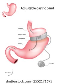 Ilustração de bandas gástricas ajustáveis. Banda gástrica laparoscópica. 