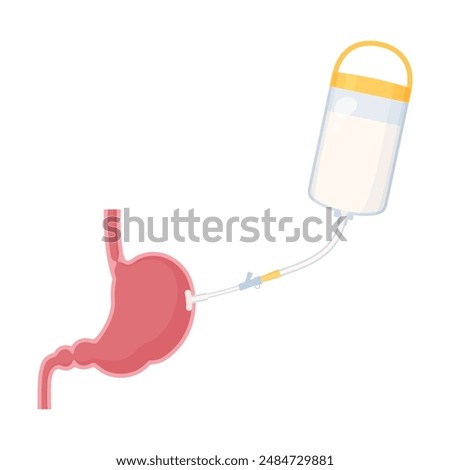 Illustration of administering nutrients through a gastrostomy tube_Cross section of stomach_PEG