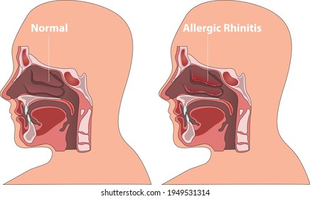 illustration of Allergic rhinitis or Hay Fever- vector