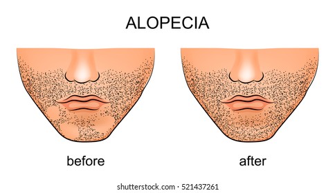 Illustration Of Alopecia Areata 
