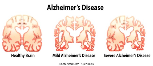 Ilustração da Doença de Alzheimer em um fundo branco