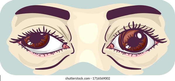 Illustration of Amblyopia or Lazy Eye with One Eye Looking Outward