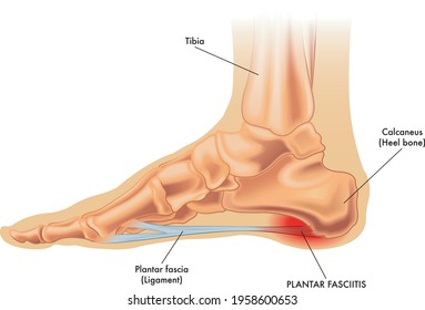 An illustration of the anatomy of a foot with the symptoms of plantar fasciitis.