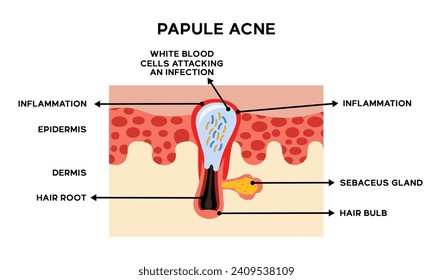 Illustration of the anatomy of papule acne skin along with an explanation of the names of each part