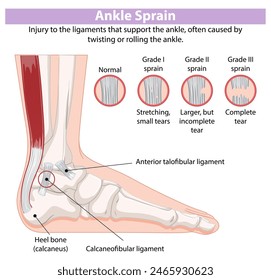 Illustration of ankle sprain grades and ligaments