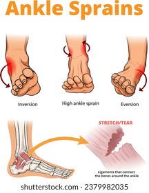 illustration of ankle sprains types