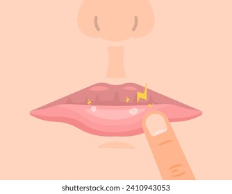 an illustration of the appearance of canker sores in the mouth. mouth sore and inflamed. feels sore because you have canker sores. oral health conditions. flat illustration design. graphic elements