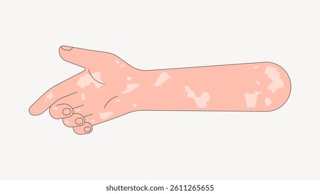 Illustration of an arm with vitiligo patches. The arm is extended, showing skin with vitiligo. Vitiligo is depicted with light patches on the skin. Arm illustration, isolated vector.