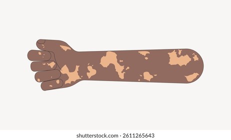 Illustration of an arm with vitiligo patches on brown skin. Vitiligo affects skin pigmentation. Arm with vitiligo showing skin pattern. Skin condition illustration. Arm illustration, isolated vector.