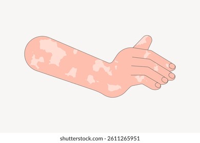 Illustration of an arm with vitiligo patches. The arm shows skin with vitiligo, highlighting skin diversity. Vitiligo patches on skin in a simple drawing. Arm illustration, isolated vector.