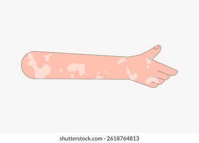 Illustration of an arm with vitiligo. Vitiligo patterns on skin. Arm showing vitiligo. Skin condition illustration. Vitiligo on arm. Arm illustration, isolated vector.