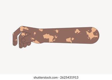 Illustration of an arm with vitiligo, showing varying skin tones. The arm is depicted with patches, highlighting vitiligo and diverse skin tones. Arm illustration, isolated vector.