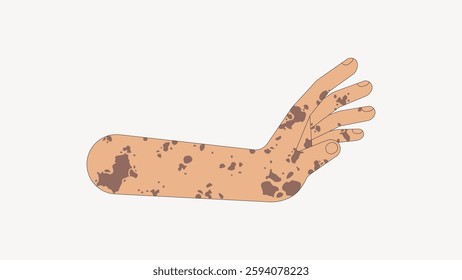 Illustration of an arm with vitiligo spots. The arm shows vitiligo, highlighting skin pigmentation. Vitiligo spots on skin, artistic depiction. Vector illustration.