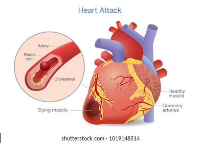 Illustration Of Arterial Thrombosis Is A Blood Clot That Develops To Heart Attack. Causes And Risk Factors For Health Problem.