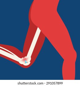 Illustration of arthritis