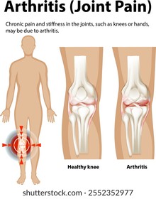 Ilustración de la artritis que afecta las articulaciones de la rodilla