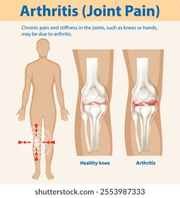 Illustration of arthritis affecting knee joints