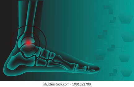 Illustration of Arthritis  ankle joint . Rheumatoid arthritis. Pain in leg. Human bone anatomy flat vector illustration. Painful injury erosion on a green technology background.