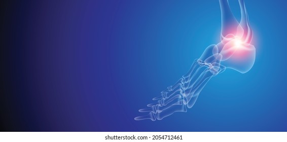 Illustration of Arthritis ankle joint . Rheumatoid arthritis.  Human bone anatomy flat vector illustration on a blue technology background. 3d rendered medically accurate illustration.